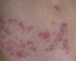 Shingles Treatment